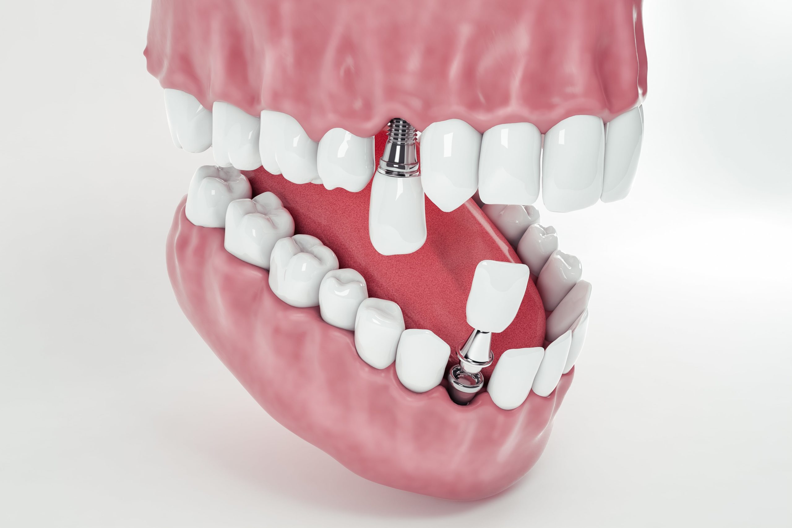 What is full mouth reconstruction in dentistry