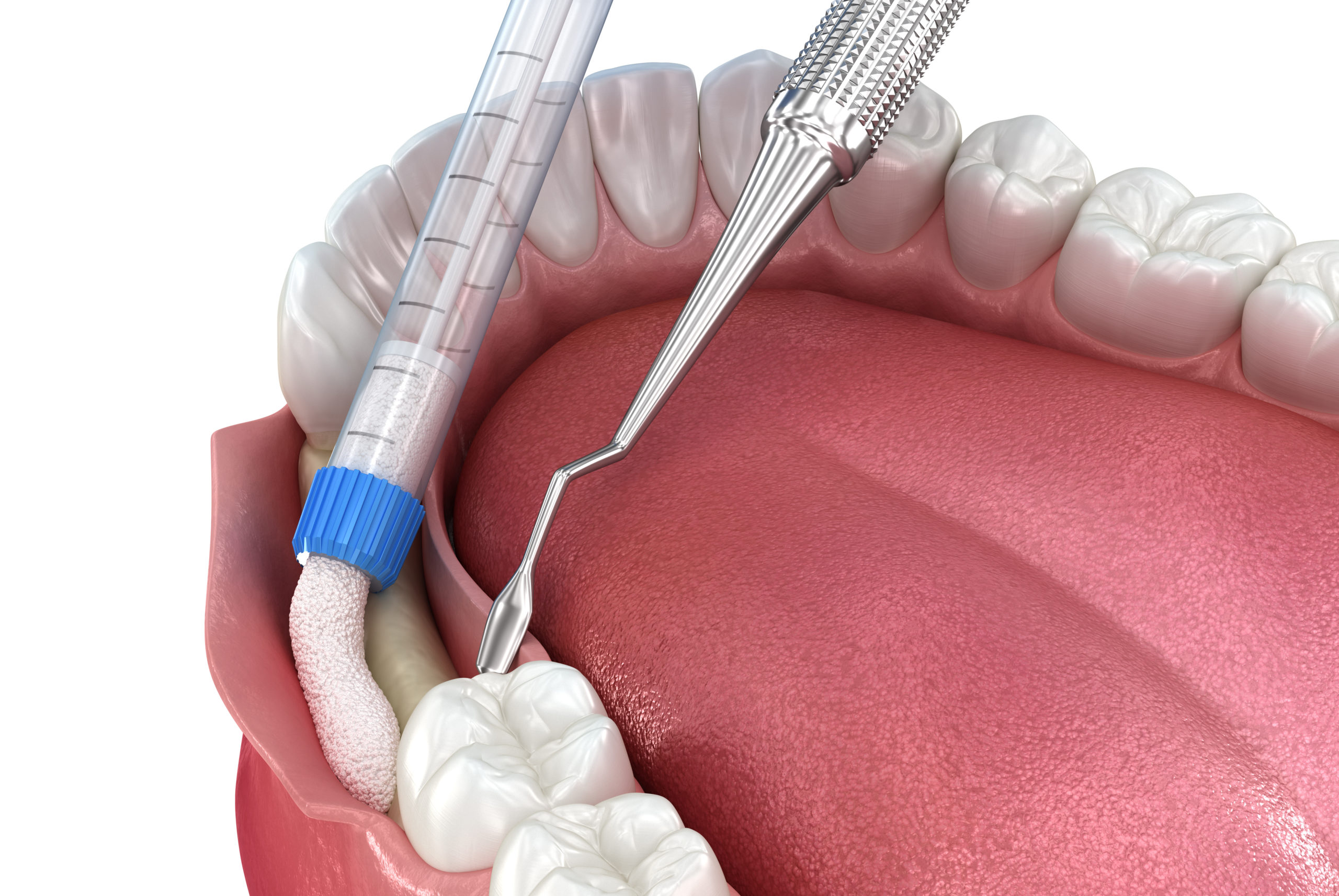 Gum Grafts: Understanding the Procedure and Its Benefits