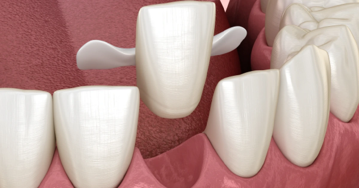 Maryland Bridge dental restoration in Los Altos, CA, showing a replacement front tooth