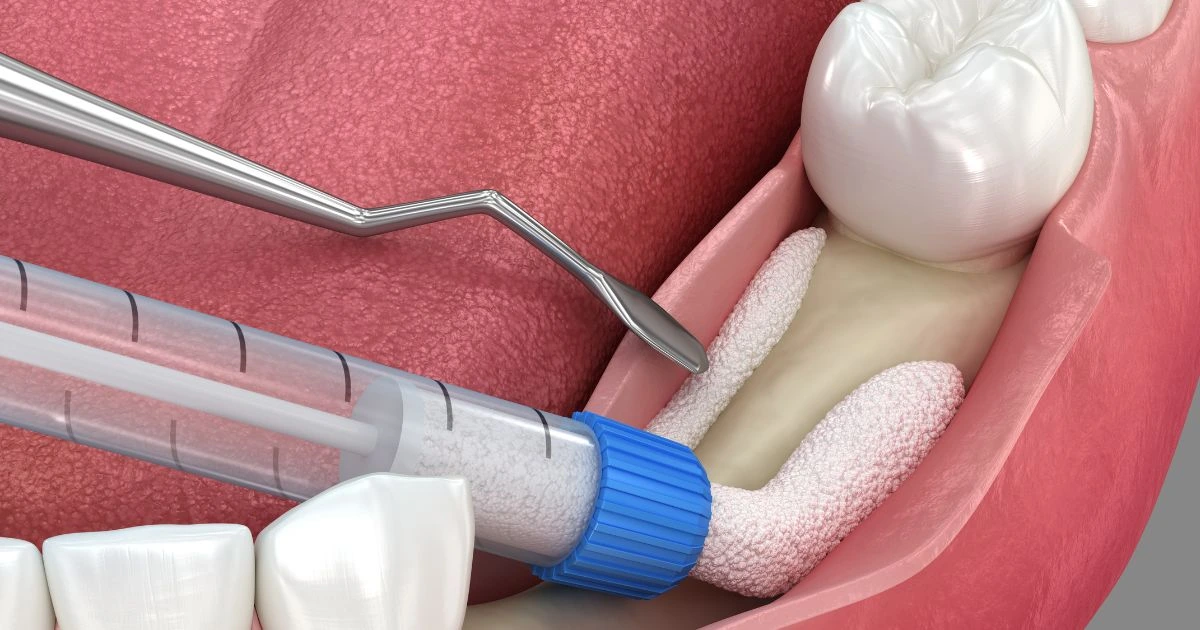 3D rendering showing the bone graft procedure being performed to rebuild jaw strength for a future dental implant.